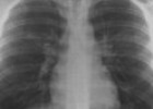 Radiografías del tórax | Recurso educativo 56357